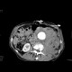 Aneurysm of abdominal aorta, AAA, ruptured, retroperitoneal bleeding: CT - Computed tomography